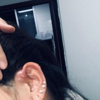 宁德哪里可以治疗耳前瘘管发炎的地方啊，不想引流手术，太遭罪了