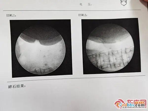 碎石神器！宁德市中医院引进国内新款大型双定位体外碎石机-6.jpg