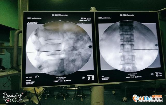 宁德市医院疼痛科开展首例C型臂引导腰交感神经阻滞术-2.jpg