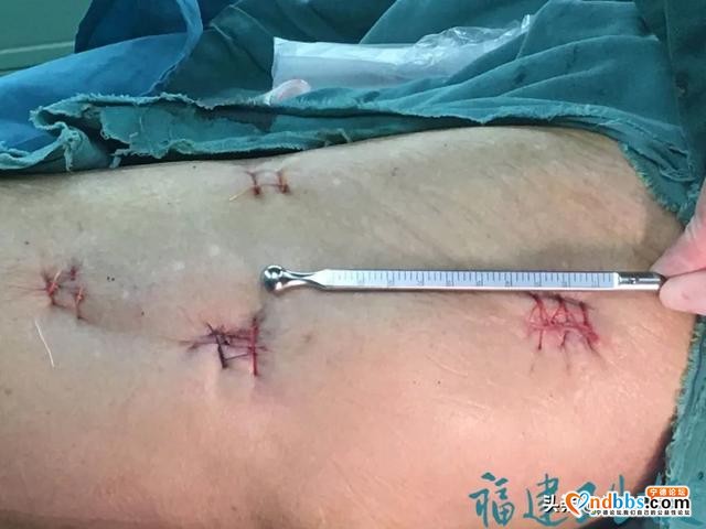 惊险！宁德109岁高龄老人遭遇“人生中最后一次骨折” ，这项手术帮他重获新生-2.jpg