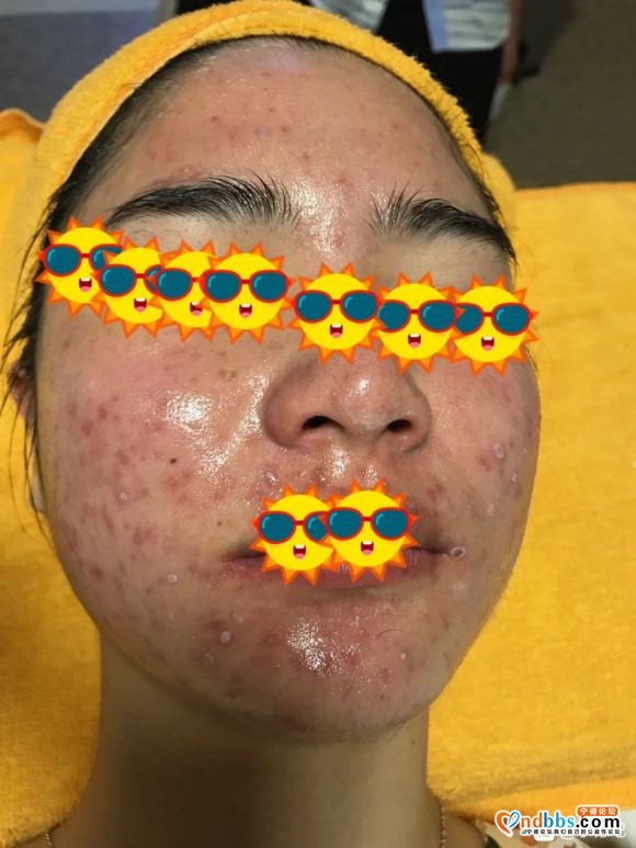 宁德看皮肤治痘痘-3.jpg