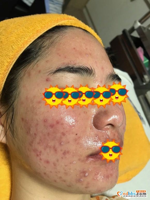 宁德看皮肤治痘痘-2.jpg