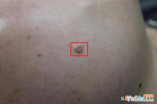 万万没想到！福安女教师脸上有“痣”5年，竟然是皮肤癌-1.jpg